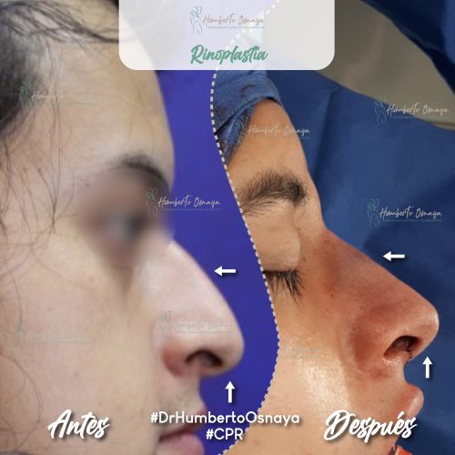 Rinoplastía caso 1