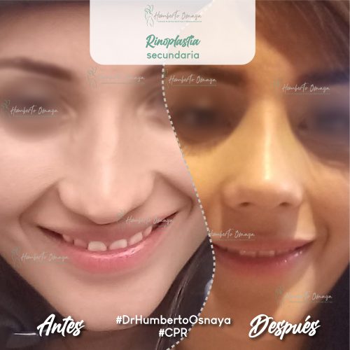 Perfil nasal